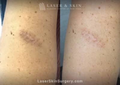LaseMD to treat post-inflammatory hyperpigmentation on the arm