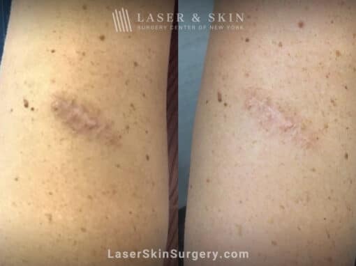 LaseMD to treat post-inflammatory hyperpigmentation on the arm