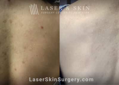 LaseMD treatments for post-inflammatory hyperpigmentation on the back