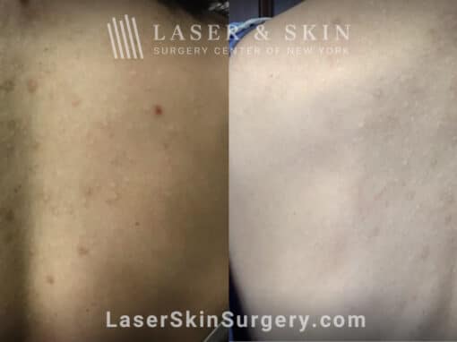 LaseMD treatments for post-inflammatory hyperpigmentation on the back