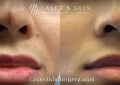 PicoPlus for post-inflammatory hyperpigmentation brown spot on the nose