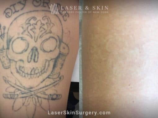 Laser tattoo removal with the PicoPlus