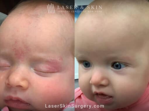 Port wine birthmark removal from baby’s face