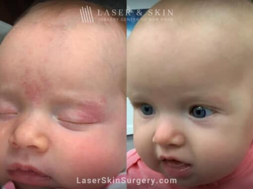 Port wine stain removal from baby’s face