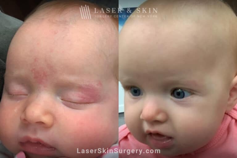 Port wine stain removal from baby’s face