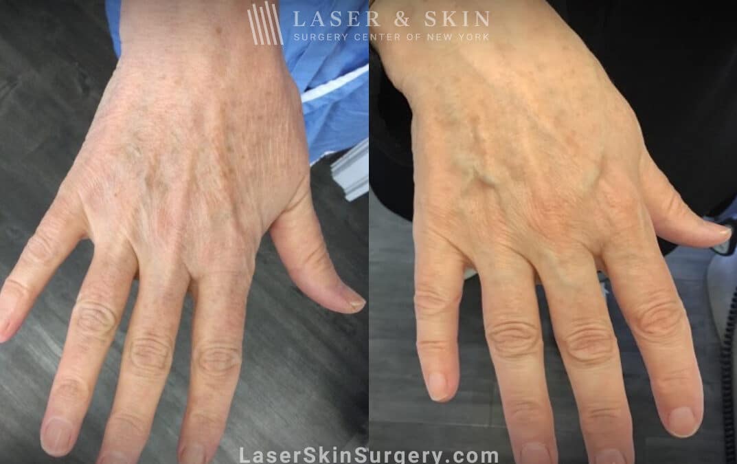 Ruby laser to remove lentigenes from the hands