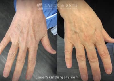 Ruby laser to remove lentigenes from the hands
