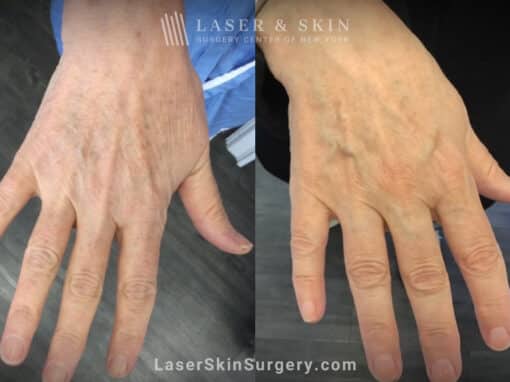 Ruby laser to remove lentigenes from the hands