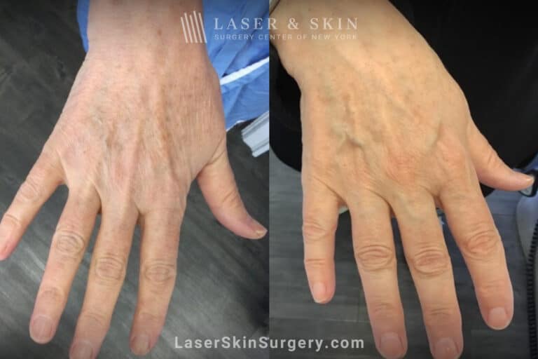 Ruby laser to remove lentigenes from the hands