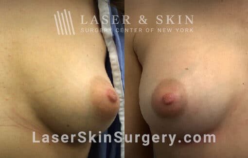 Breast augmentation to reshape the breasts