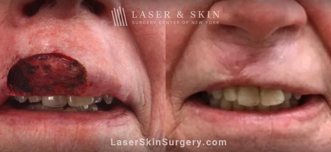 Mohs surgery for skin cancer on the upper lip