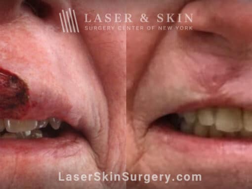 Mohs surgery for skin cancer on the upper lip