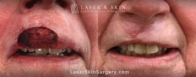 Mohs surgery for skin cancer on the upper lip