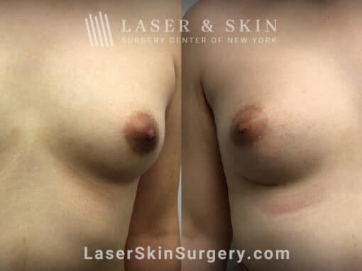 Breast augmentation for transgender patient to increase the breast size