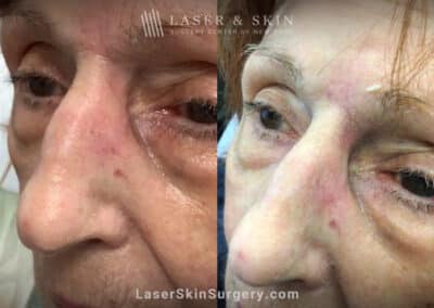 Erbium laser skin resurfacing to remove scar