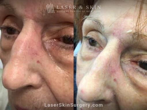 Erbium laser skin resurfacing to remove scar