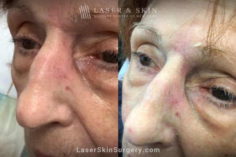 Erbium laser skin resurfacing to remove scar