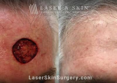 Excision surgery to remove melanoma from the forehead