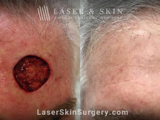 Excision surgery to remove melanoma from the forehead