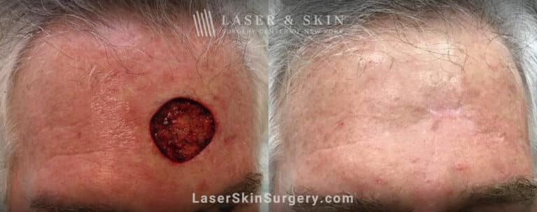 Excision surgery to remove melanoma from the forehead