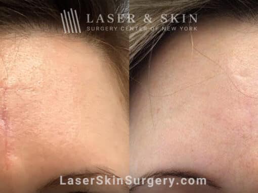 Genius microneedling to treat scar on the forehead