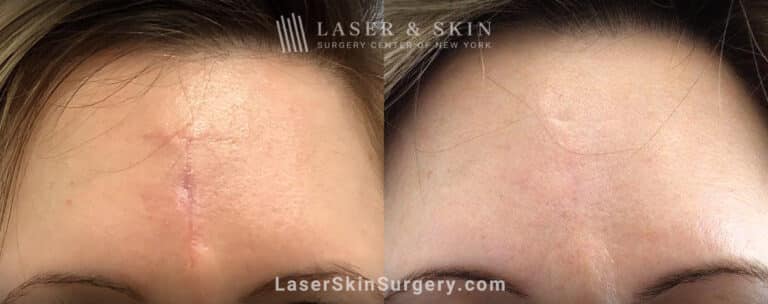 Genius microneedling to treat scar on the forehead