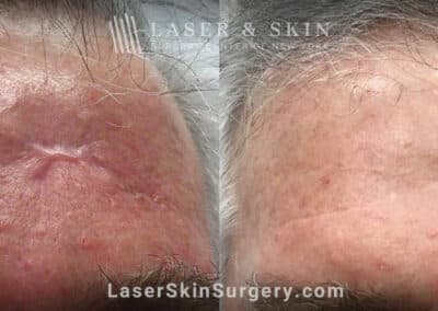 Laser scar removal with the Fraxel