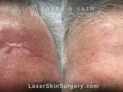 Laser scar removal with the Fraxel