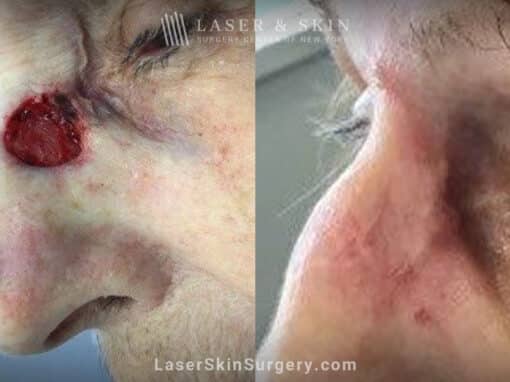 Mohs surgery to remove skin cancer from the nose