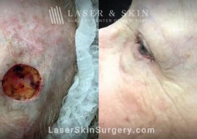 Mohs surgery to remove skin cancer from the temple