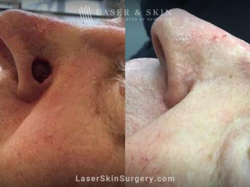 Mohs surgery to remove skin cancer from the nose