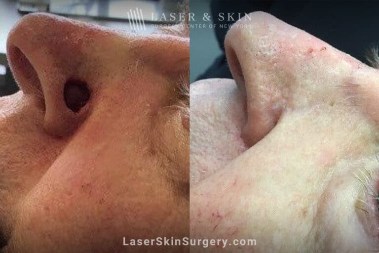 Mohs surgery to remove skin cancer from the nose