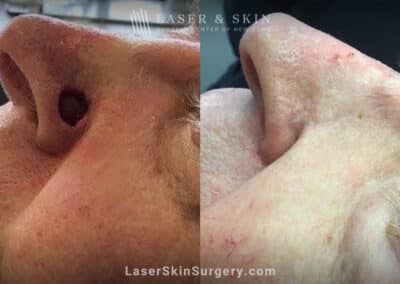 Mohs surgery to treat skin cancer on the nose