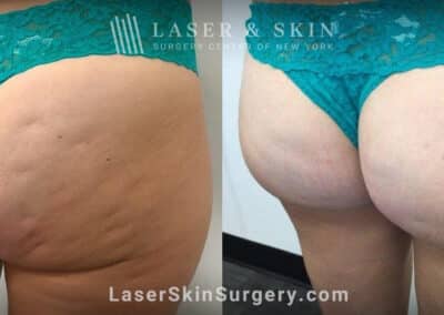 Resonic treatments for cellulite on the buttocks