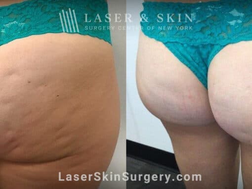 Resonic treatments for cellulite on the buttocks