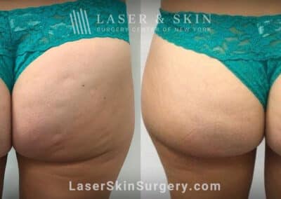 Resonic treatments for cellulite on the buttocks