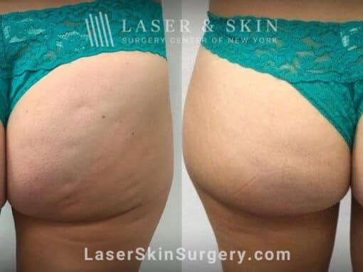 Resonic treatments for cellulite on the buttocks