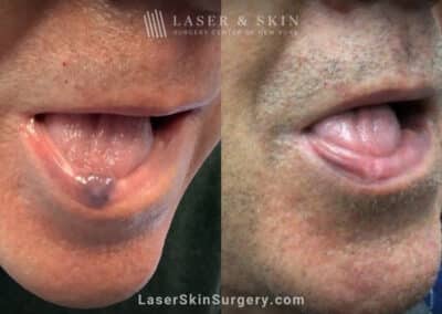Excel V laser to remove venous lake from the lip