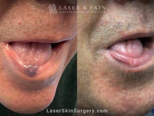 Excel V laser to remove venous lake from the lip