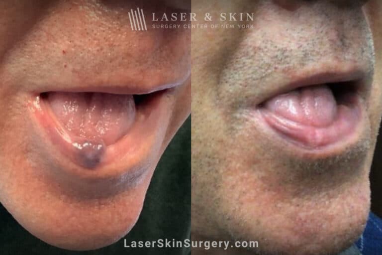 Excel V laser to remove venous lake from the lip