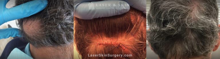 Excision surgery to remove lipoma from the scalp