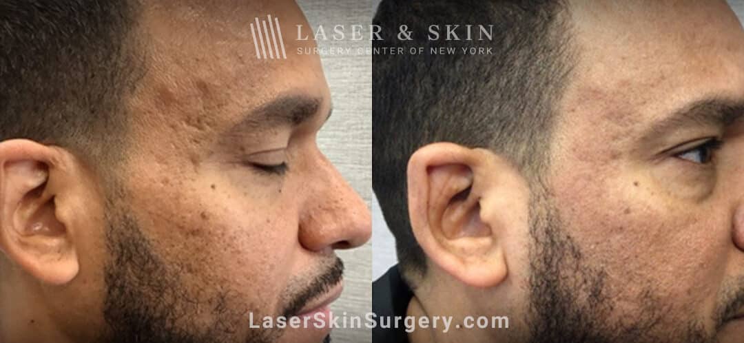 laser treatment for acne scars in nyc