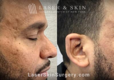 Fraxel Repair to remove acne scars from the face