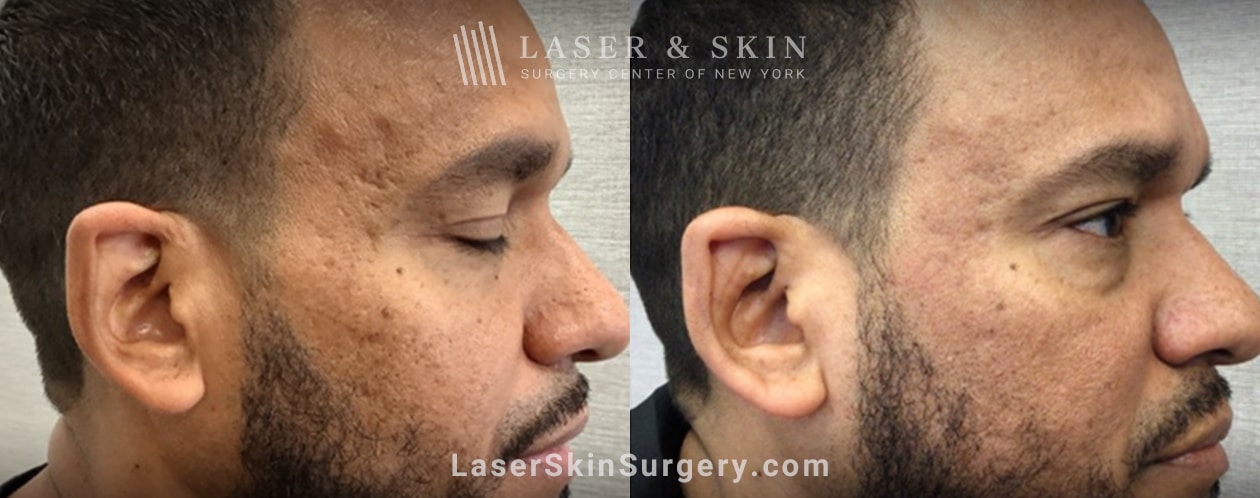 boxcar acne scars laser treatment in nyc