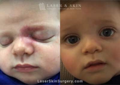 Laser treatment for port wine birthmark