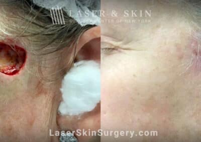 Mohs surgery to treat skin cancer on the temple