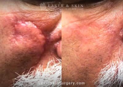 Active FX CO2 laser resurfacing to treat scar on nose and cheek