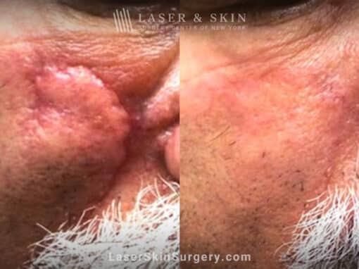 Active FX CO2 laser resurfacing to treat scar on nose and cheek