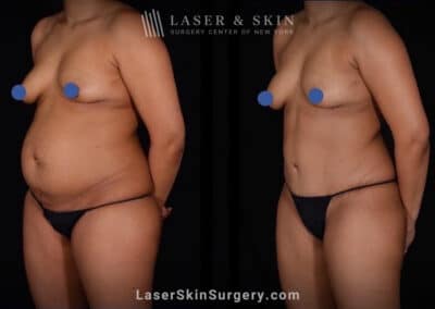 Abdominoplasty and Liposuction to Contour the Abdomen