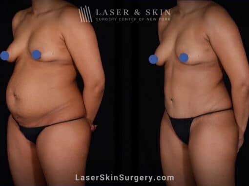 Abdominoplasty and Liposuction to Contour the Abdomen